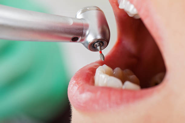 Best Emergency Dentist for Lost Fillings or Crowns in Manchester, PA